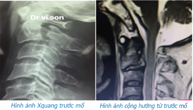 Ảnh chụp X quang và cộng hưởng từ trước  khi phẫu thuật (BVCC).