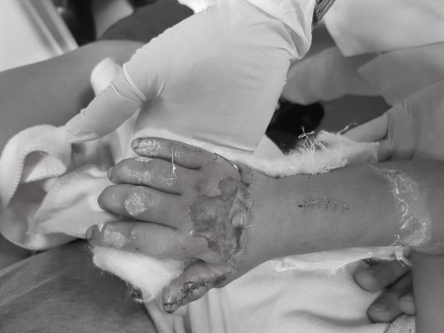 Phẫu thuật vi phẫu nối bàn tay phải đứt gần rời cho bé gái 3 tuổi (NVCC).