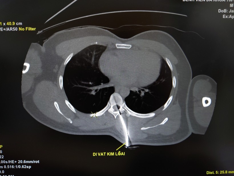 Hình dị vật kim loại trên phim CT ngực.