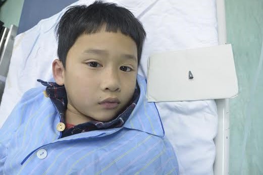 Bé trai 7 tuổi nuốt dị vật vào phế quản được cứu sống