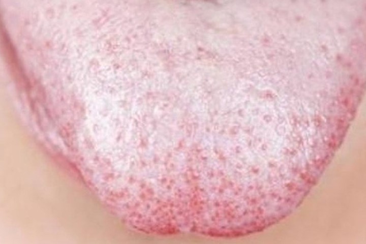 Màu sắc của lưỡi cảnh báo một số bệnh