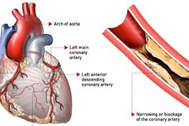 Bệnh mạch vành có thể dẫn tới các cơn nhồi máu cơ tim hết sức nguy hiểm. Ảnh: cardiodx.com