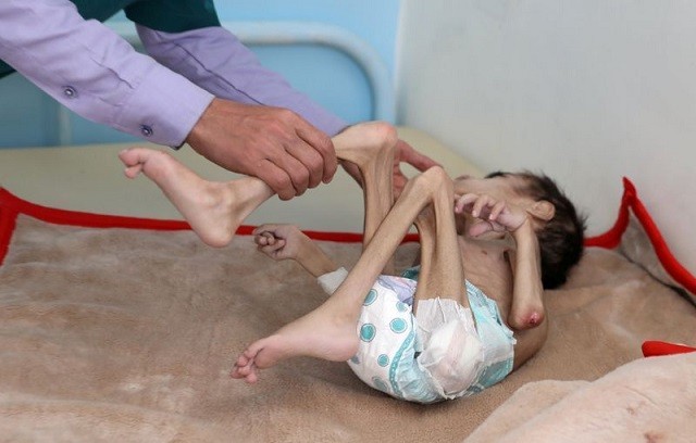 Cậu bé Faid Samim nặng 7kg vì nạn đói.