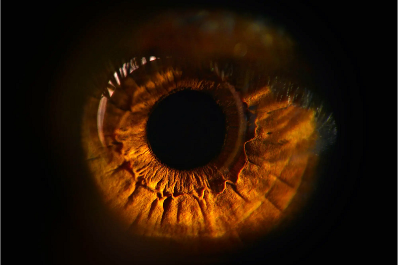 Thoái hóa điểm vàng là một bệnh về mắt ảnh hưởng đến phần trung tâm của võng mạc, được gọi là điểm vàng. Nó dẫn đến mất thị lực trung tâm, gây khó khăn cho việc đọc, lái xe và nhận dạng khuôn mặt.
