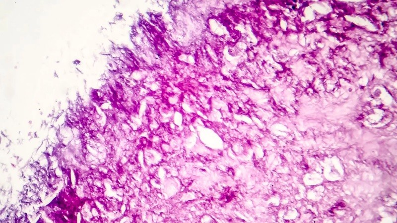 Một ví dụ về các tế bào khối u ác tính. (Ảnh: Canva)