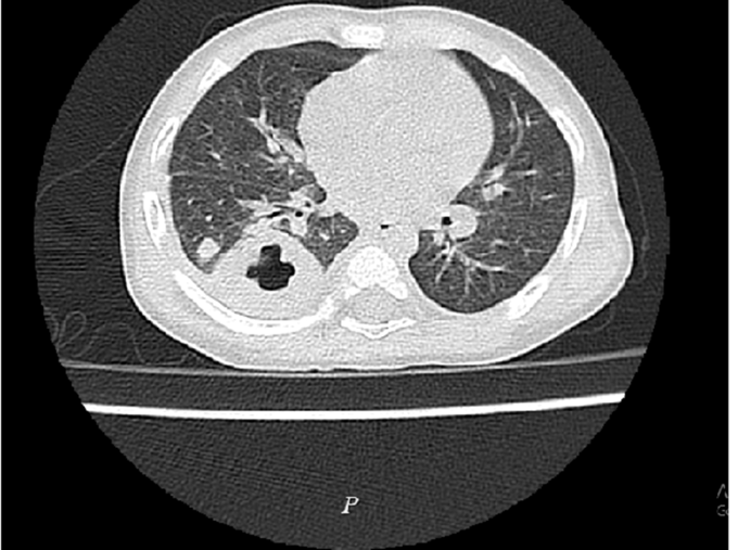 Ảnh X-quang tình trạng nhiễm khuẩn huyết, áp xe phổi do vi khuẩn Whitmore. Ảnh: Bệnh viện cung cấp.