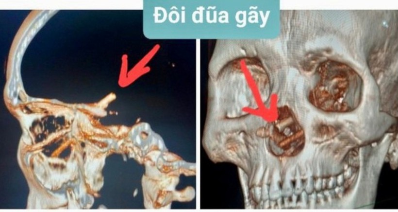 Hình ảnh chụp CT Scanner sọ não phát hiện dị vật trong mũi bệnh nhân.