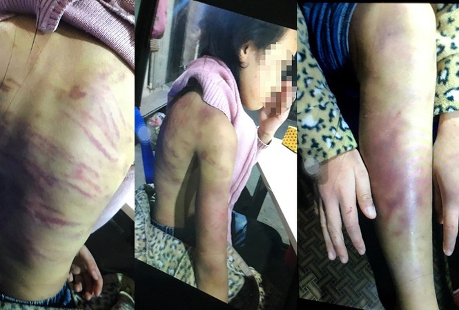 Hình ảnh các vết thương trên người cháu B. được cho là bị mẹ bạo hành.