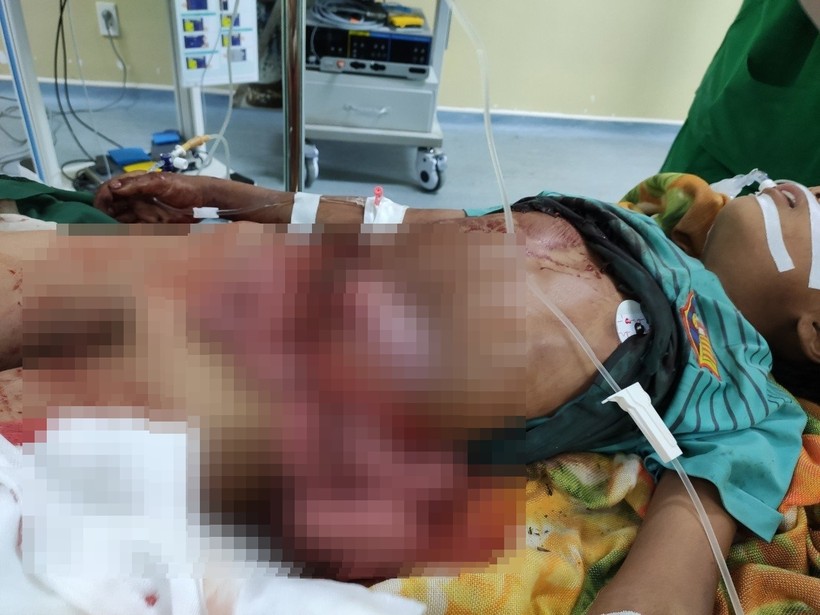 Bệnh nhân bị toạc ngang thành bụng vừa được Bệnh viện Đa khoa tỉnh Kon Tum cứu sống.