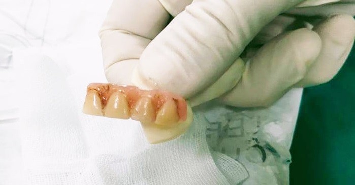 4 chiếc răng giả bệnh nhân nuốt vào hành tá tràng được lấy ra thành công.