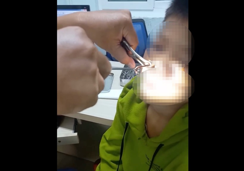 Bác sĩ gắp con vắt dài 8cm trong mũi bệnh nhân 15 tuổi.