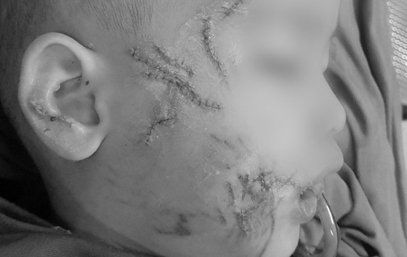 Bé trai bị chó cắn gây thương tích nặng vùng mặt và vùng đầu. Ảnh: NLĐ