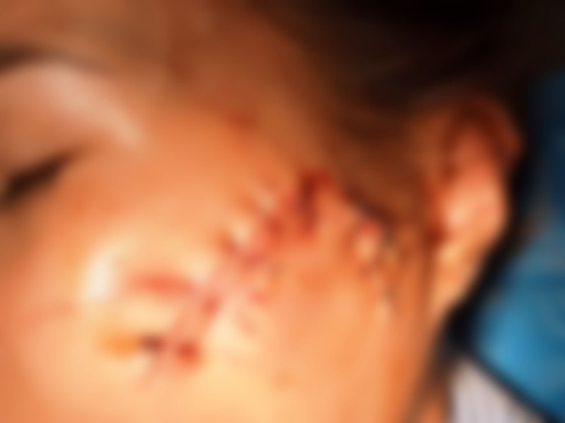 Vết thương trên mặt chị Trịnh Thị Hoa L. Ảnh: Gia đình nạn nhân cung cấp.