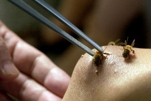 Sử dụng nọc ong có độc trong điều trị bệnh