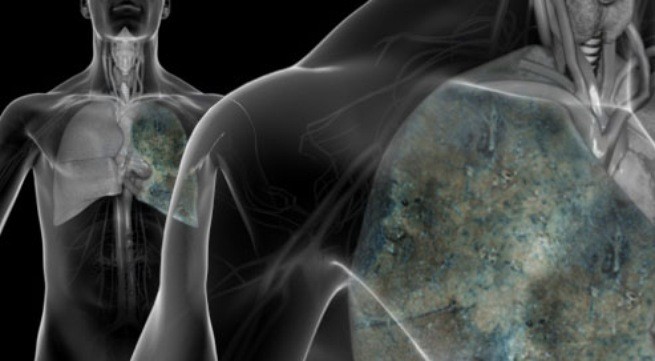Cách phát hiện và điều trị ung thư phổi