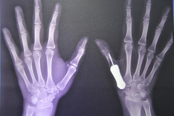 
Hình chụp bàn tay của bệnh nhân sau khi được ghép xương titan. Ảnh:The Nation/ANN.