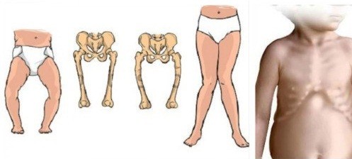 Còi xương gây dị dạng xương ở trẻ.