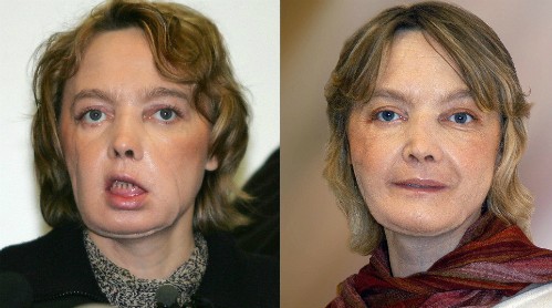 Khuôn mặt của Dinoire ngay sau ca phẫu thuật vào năm 2005 (trái) và năm 2006 (phải). Ảnh:CNN.
