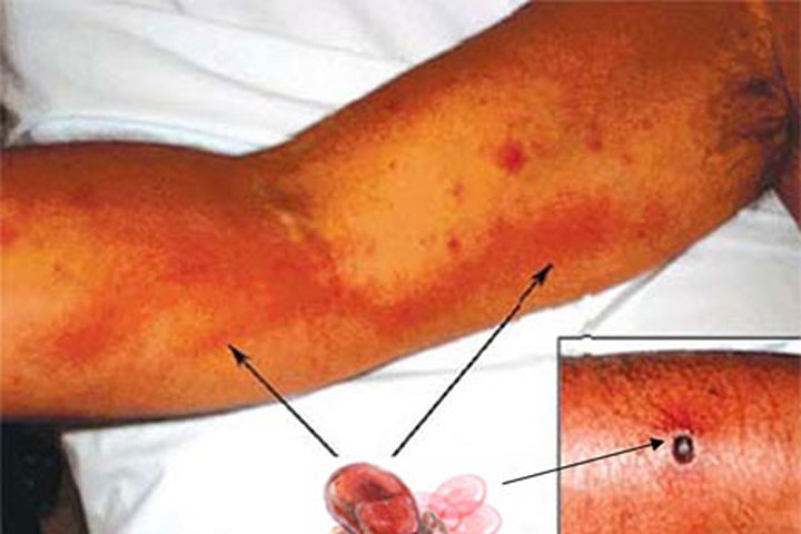 Những điều cần biết về virus gây bệnh sốt mò nguy hiểm