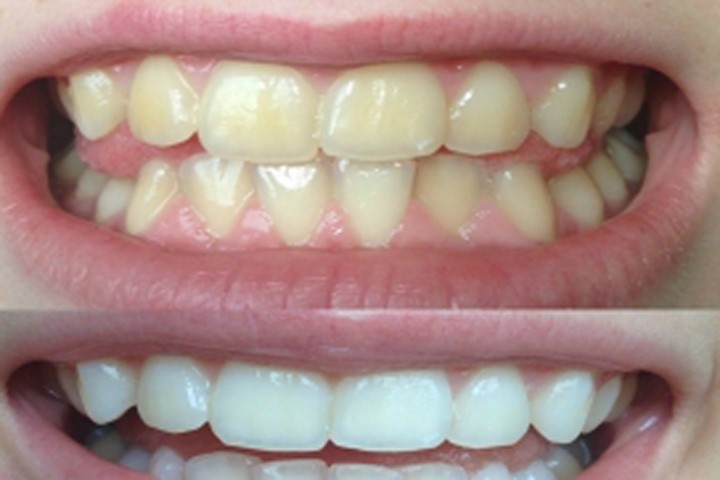 Răng trắng sáng gấp 8 lần trong vòng 2 phút nhờ "thần dược" này