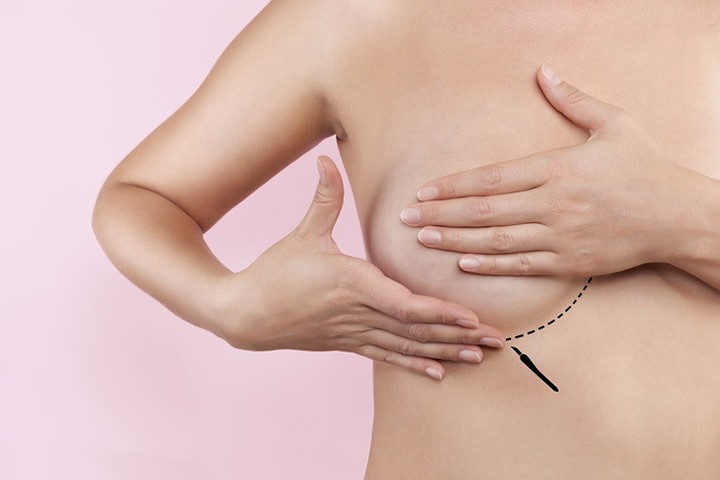 Hai mặt của những biện pháp nâng ngực phổ biến