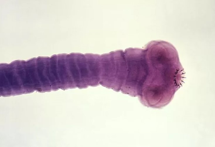 Ấu trùng sán dây làm tổ trong não người phụ nữ ở Australia