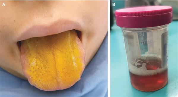 Bệnh lạ khiến lưỡi cậu bé 12 tuổi chuyển màu vàng 