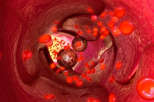 Khả năng kháng ferroptosis được phát hiện là đặc điểm chính của các tế bào ung thư di căn.