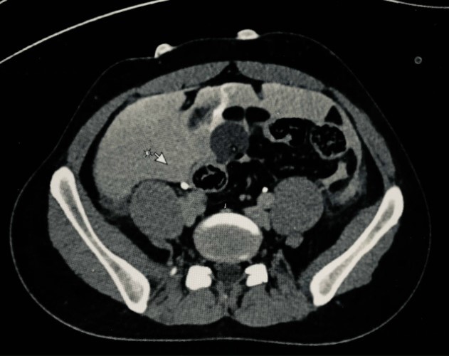 Hình ảnh chụp CT của bệnh nhân. Ảnh: BVCC.