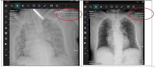 Hình ảnh phổi của bệnh nhân nữ 80 tuổi trước và sau điều trị. Ảnh: BSCC.