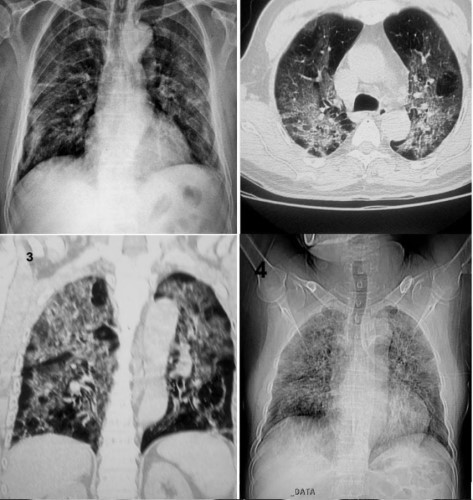 Hình ảnh tổn thương phổi hậu Covid-19. Ảnh: BSCC.
