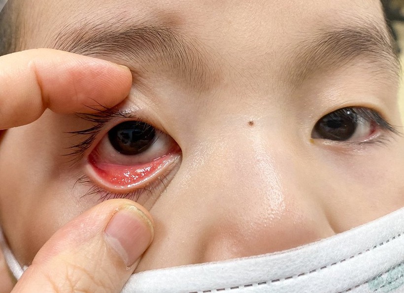 Trẻ đau mắt hậu Covid-19 điều trị tại Bệnh viện Nhi Trung ương.