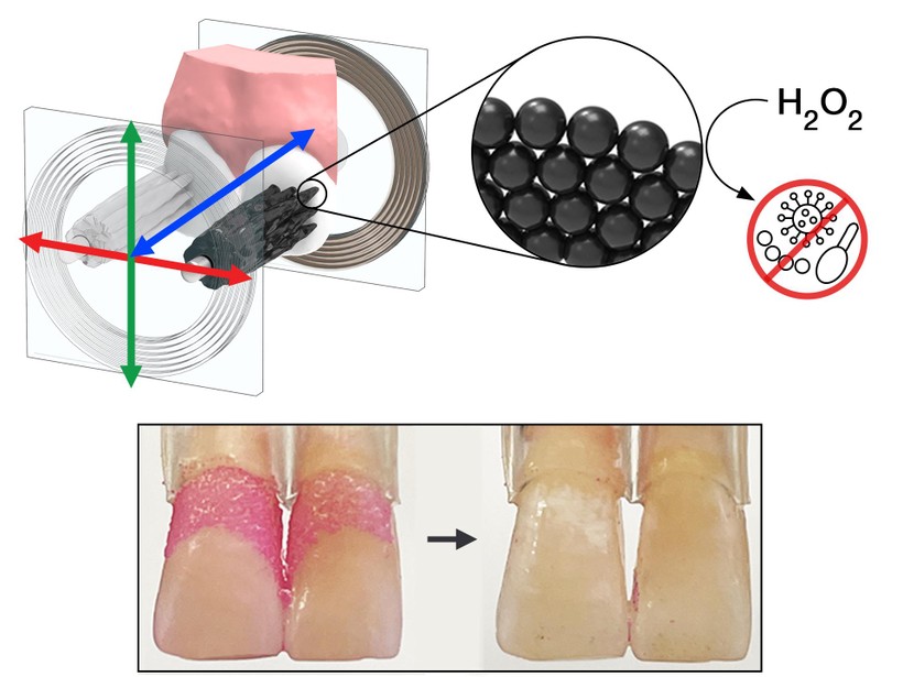 Được sắp xếp theo cấu trúc giống như lông bàn chải, một đám robot nhỏ chứa các hạt nano oxit sắt làm sạch hiệu quả mảng bám trên răng.