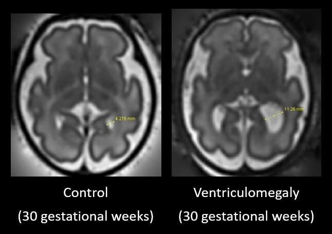 Các nhà nghiên cứu đã sử dụng hình ảnh chụp cộng hưởng từ não của trẻ em bị chứng giãn não thất thai nhi.