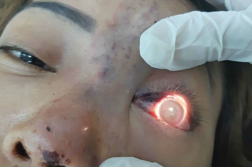 Một trường hợp bị mù mắt sau khi tiêm filler ở cơ sở thẩm mỹ chui. 