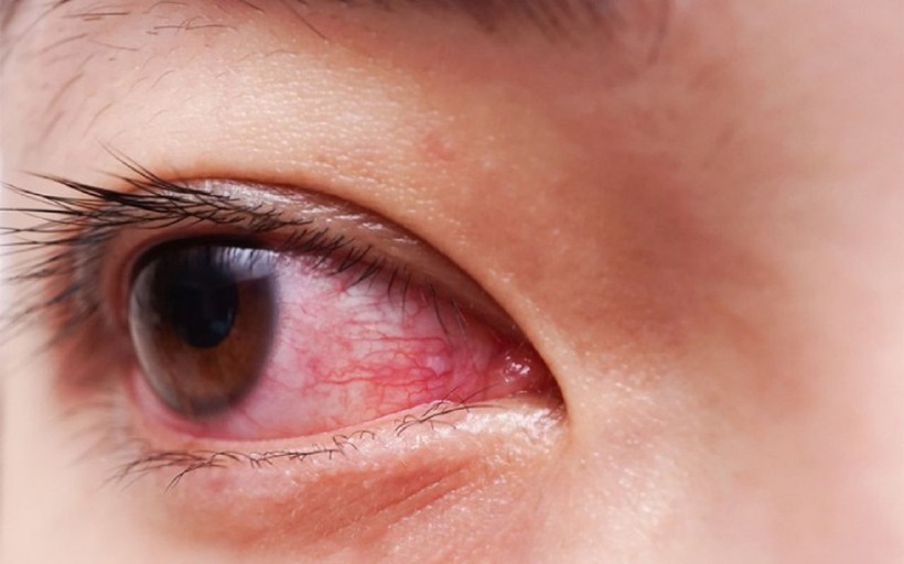 Nhiều bệnh nhân rơi vào tình trạng đau mắt đỏ nặng hơn do tự điều trị. Ảnh minh họa.