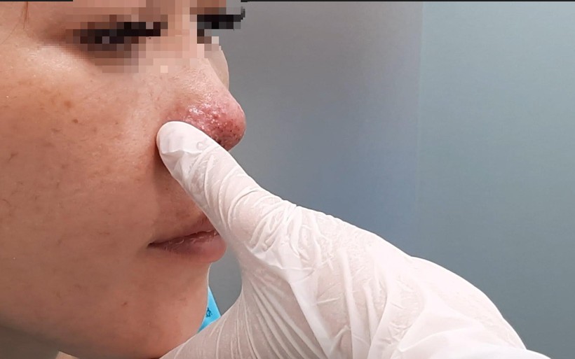 Một bệnh nhân biến chứng do tiêm filler nâng mũi. 
