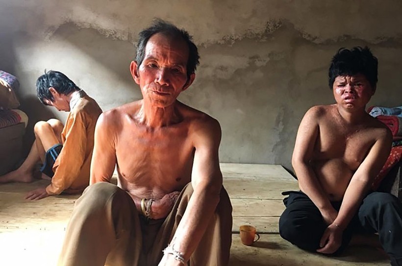 Ông Xa Văn Chiều cùng 2 người con trai mắc bệnh khô da sắc tố (ảnh chụp năm 2017).