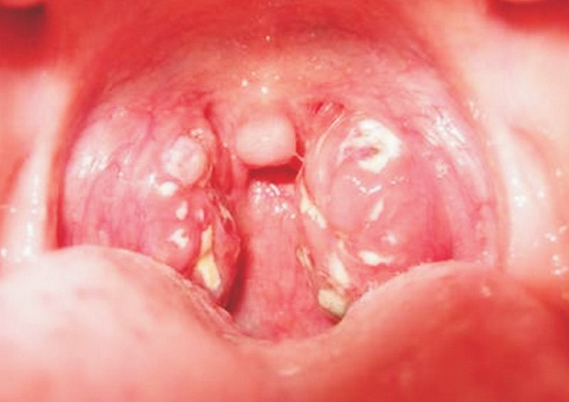 Vùng hầu họng của bệnh nhân thường đặc trưng, có tổn thương giả mạc trắng, khó bóc.