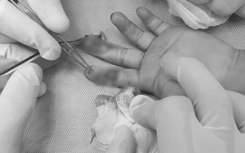 Bệnh nhi đứt ngón tay được điều trị tại Bệnh viện Nhi Trung ương. Ảnh: BVCC