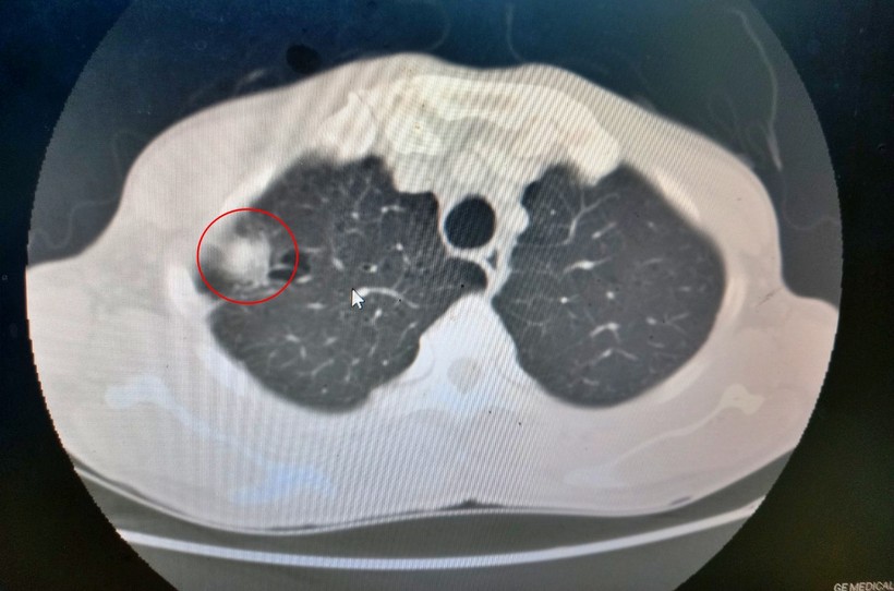 Khối u ác tính phổi phải của bệnh nhân H. trên phim chụp cắt lớp vi tính. Ảnh: BVCC