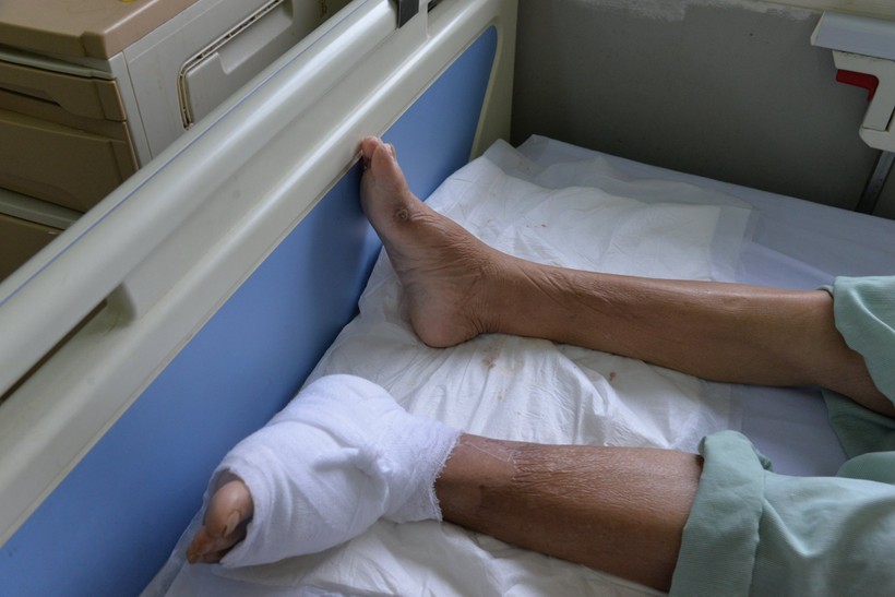 Với người bệnh đái tháo đường, biến chứng loét chân là nguyên nhân hàng đầu gây cắt cụt chi không phải do chấn thương. Ảnh: BV Nội tiết Trung ương