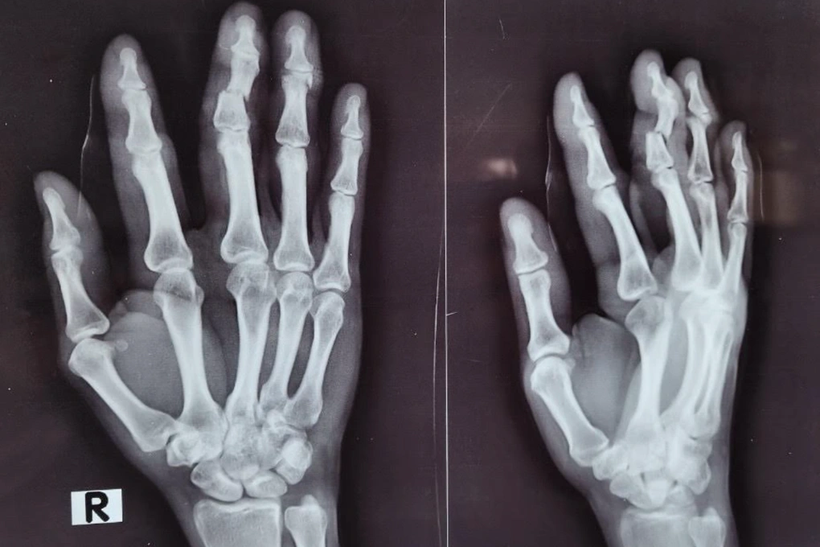 Ảnh chụp X-quang đánh giá các vết thương ở bàn tay của người phụ nữ. Ảnh: BVCC. 