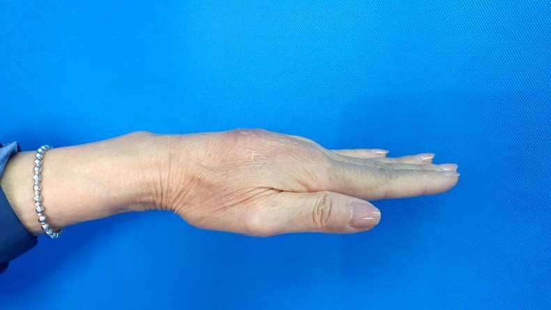 Một trường hợp biến chứng u hạt khi tiêm filler tay. Ảnh: BVCC