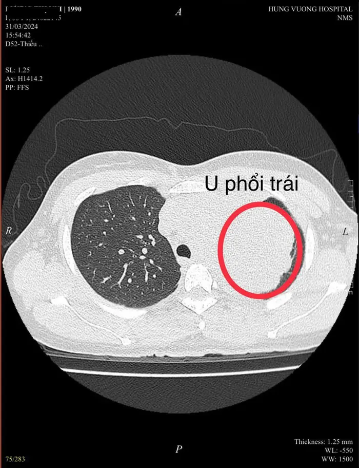 Kết quả chụp cắt lớp vi tính phổi của bệnh nhân, phát hiện khối u thùy trên phổi trái rất to 9x12 cm. Ảnh: BVCC 