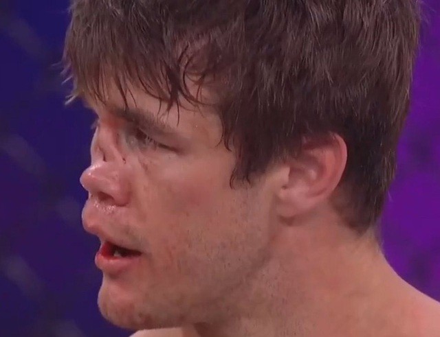 Mũi của võ sĩ MMA biến dạng sau khi lĩnh cú đá từ đối thủ.