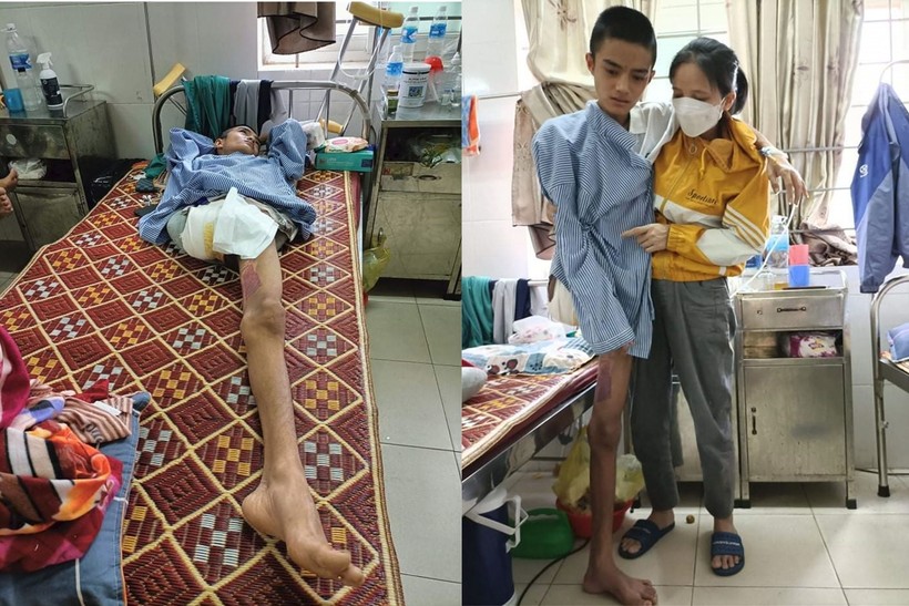 Thân hình cậu học trò bị tháo khớp chân phải, gầy gò yếu ớt sau nhiều tháng điều trị ở bệnh viện.
