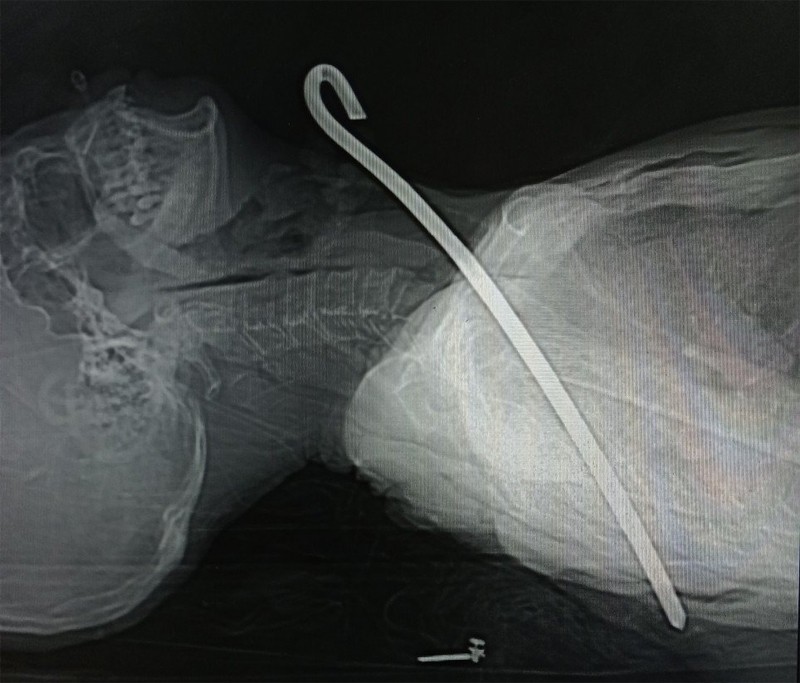 Hình ảnh chụp X-quang cho thấy cây sắt đâm xuyên từ cổ đến phổi bệnh nhân. (Ảnh: BVHT).