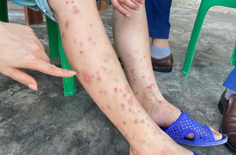 Sau khi bị bò chét cắn, nhiều người dân ở Hà Tĩnh xuất hiện sẩn ngứa khắp người. (Ảnh: SYT Hà Tĩnh).