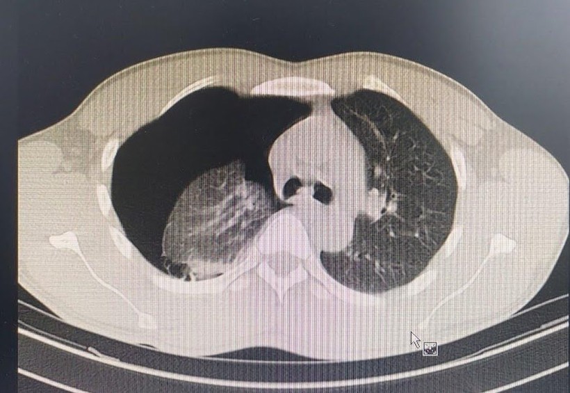 Kết quả Phim CT nhu mô phổi bị xẹp do tràn khí màng phổi. Ảnh: BVCC.